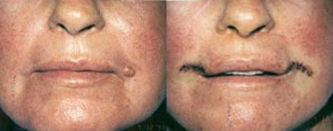 Lips before and after photos in San Francisco, CA, Patient 13262