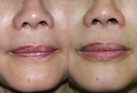 Lips before and after photos in San Francisco, CA, Patient 13277