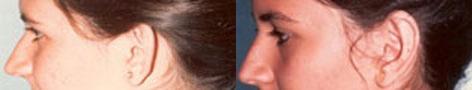 Otoplasty before and after photos in San Francisco, CA, Patient 13307