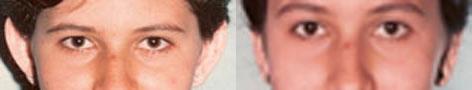 Otoplasty before and after photos in San Francisco, CA, Patient 13307