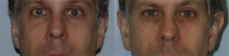 Otoplasty before and after photos in San Francisco, CA, Patient 13314