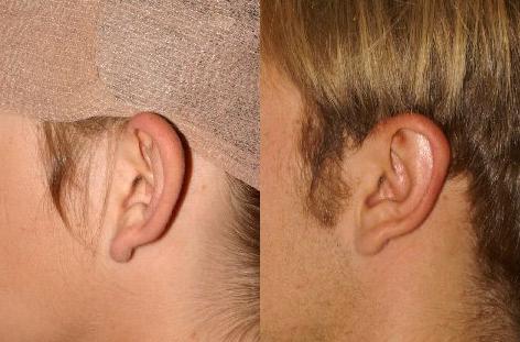 Otoplasty before and after photos in San Francisco, CA, Otoplasty in San Francisco, CA