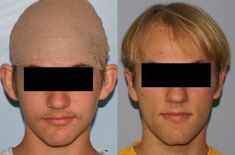 Otoplasty before and after photos in San Francisco, CA, Patient 13317