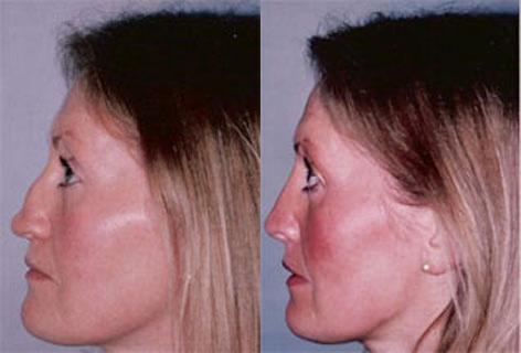 Rhinoplasty before and after photos in San Francisco, CA, Patient 13333