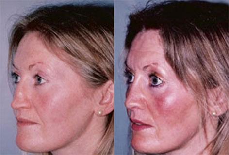 Rhinoplasty before and after photos in San Francisco, CA, Patient 13333