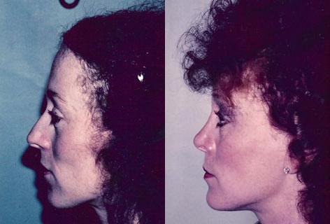 Rhinoplasty before and after photos in San Francisco, CA, Patient 13338