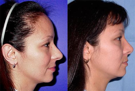 Rhinoplasty before and after photos in San Francisco, CA, Patient 13343