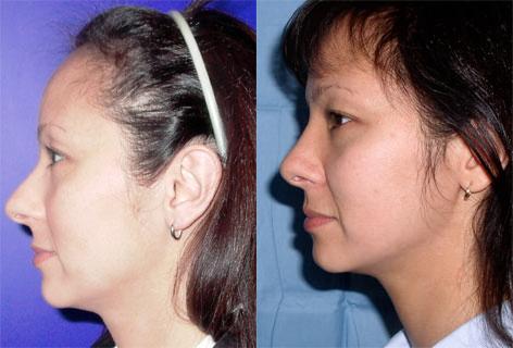 Rhinoplasty before and after photos in San Francisco, CA, Patient 13343