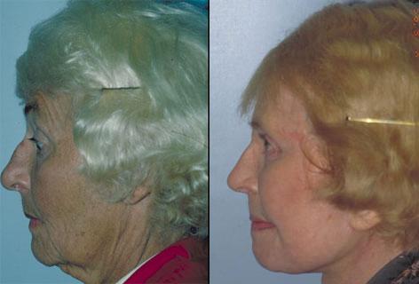 Rhinoplasty before and after photos in San Francisco, CA, Patient 13350