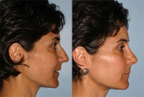 Rhinoplasty before and after photos in San Francisco, CA, Patient 13355