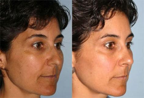 Rhinoplasty before and after photos in San Francisco, CA, Patient 13355