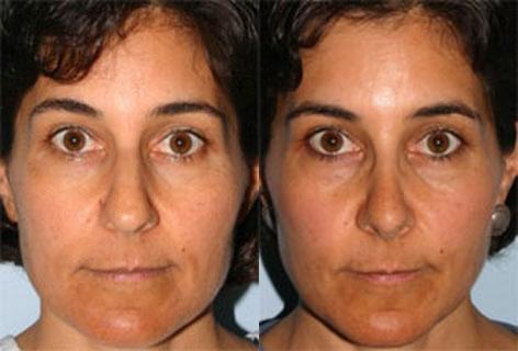 Rhinoplasty before and after photos in San Francisco, CA, Rhinoplasty in San Francisco, CA