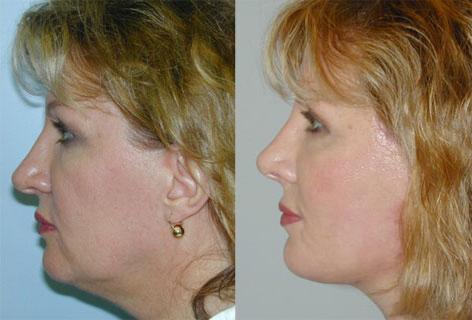 Rhinoplasty before and after photos in San Francisco, CA, Patient 13362