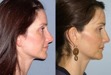 Rhinoplasty before and after photos in San Francisco, CA, Patient 13369