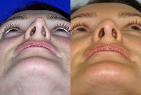 Rhinoplasty before and after photos in San Francisco, CA, Patient 13369