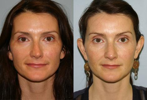 Rhinoplasty before and after photos in San Francisco, CA, Patient 13369
