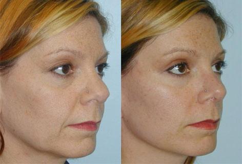 Rhinoplasty before and after photos in San Francisco, CA, Patient 13376