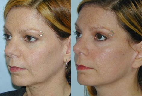 Rhinoplasty before and after photos in San Francisco, CA, Patient 13376