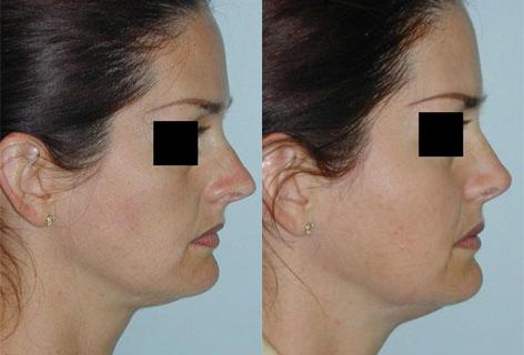 Rhinoplasty before and after photos in San Francisco, CA, Patient 13383