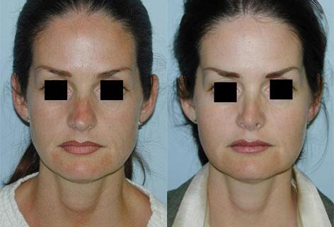 Rhinoplasty before and after photos in San Francisco, CA, Patient 13383