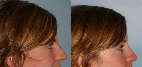 Rhinoplasty before and after photos in San Francisco, CA, Patient 13388