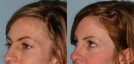 Rhinoplasty before and after photos in San Francisco, CA, Patient 13388