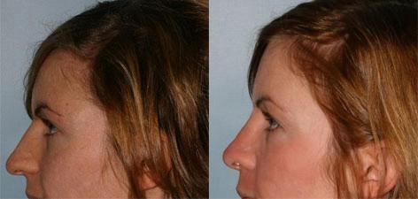 Rhinoplasty before and after photos in San Francisco, CA, Patient 13388