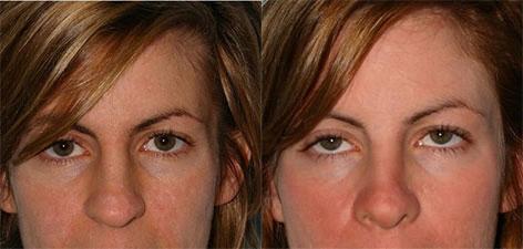 Rhinoplasty before and after photos in San Francisco, CA, Patient 13388