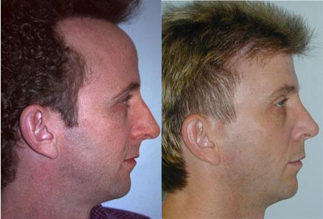 Rhinoplasty before and after photos in San Francisco, CA, Patient 13397