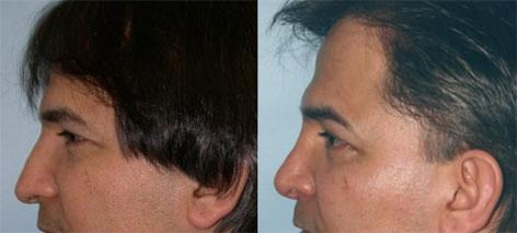 Rhinoplasty before and after photos in San Francisco, CA, Patient 13402