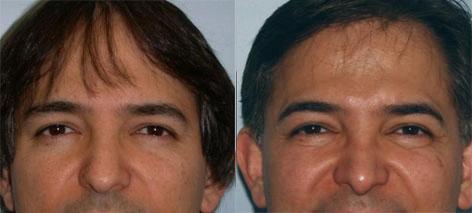 Rhinoplasty before and after photos in San Francisco, CA, Patient 13402