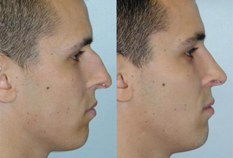 Rhinoplasty before and after photos in San Francisco, CA, Patient 13407