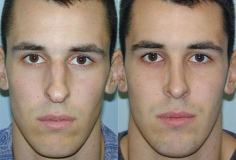 Rhinoplasty before and after photos in San Francisco, CA, Patient 13407