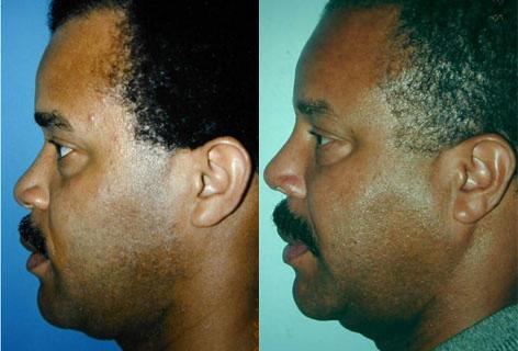 Rhinoplasty before and after photos in San Francisco, CA, Patient 13412