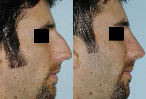 Rhinoplasty before and after photos in San Francisco, CA, Patient 13417