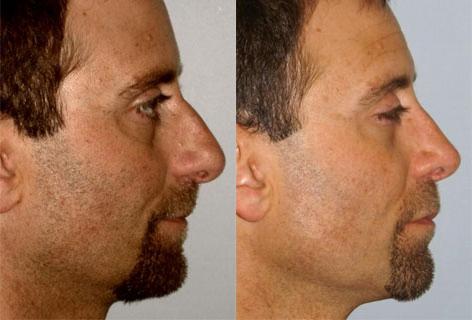 Rhinoplasty before and after photos in San Francisco, CA, Patient 13420