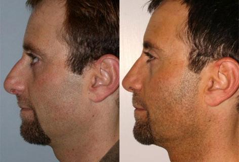 Rhinoplasty before and after photos in San Francisco, CA, Patient 13420