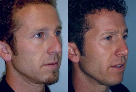 Rhinoplasty before and after photos in San Francisco, CA, Patient 13427