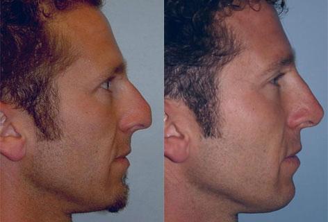 Rhinoplasty before and after photos in San Francisco, CA, Patient 13427