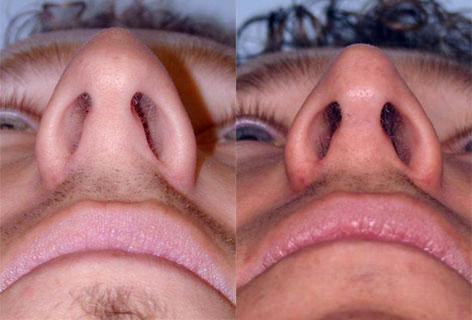 Rhinoplasty before and after photos in San Francisco, CA, Patient 13427