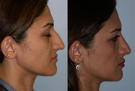 Rhinoplasty before and after photos in San Francisco, CA, Patient 13436