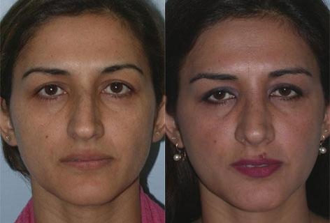 Rhinoplasty before and after photos in San Francisco, CA, Patient 13436