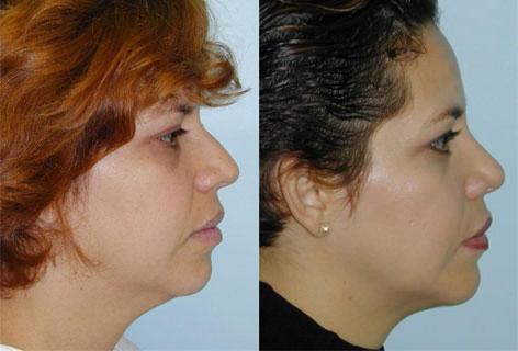 Rhinoplasty before and after photos in San Francisco, CA, Patient 13441