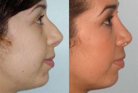 Rhinoplasty before and after photos in San Francisco, CA, Patient 13446