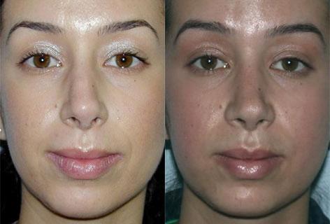 Rhinoplasty before and after photos in San Francisco, CA, Patient 13446