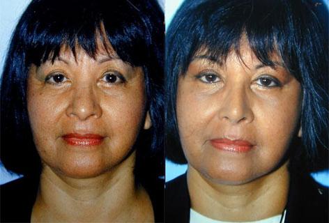 Rhinoplasty before and after photos in San Francisco, CA, Patient 13451