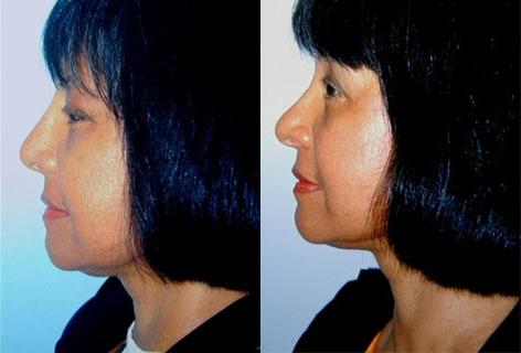 Rhinoplasty before and after photos in San Francisco, CA, Patient 13451