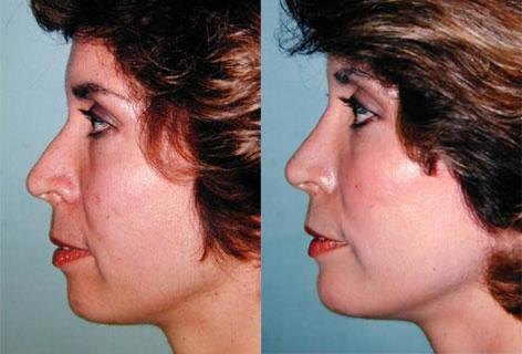 Rhinoplasty before and after photos in San Francisco, CA, Patient 13456