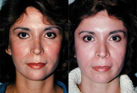 Rhinoplasty before and after photos in San Francisco, CA, Patient 13456