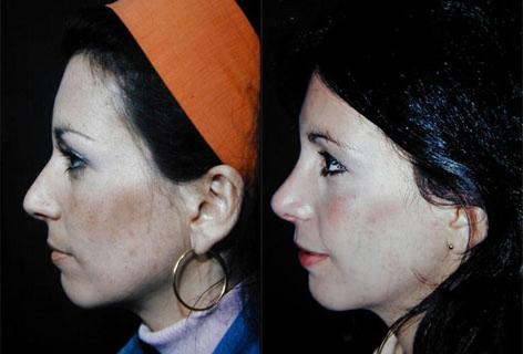 Rhinoplasty before and after photos in San Francisco, CA, Patient 13461